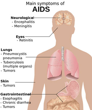 Insurance for HIV AIDS